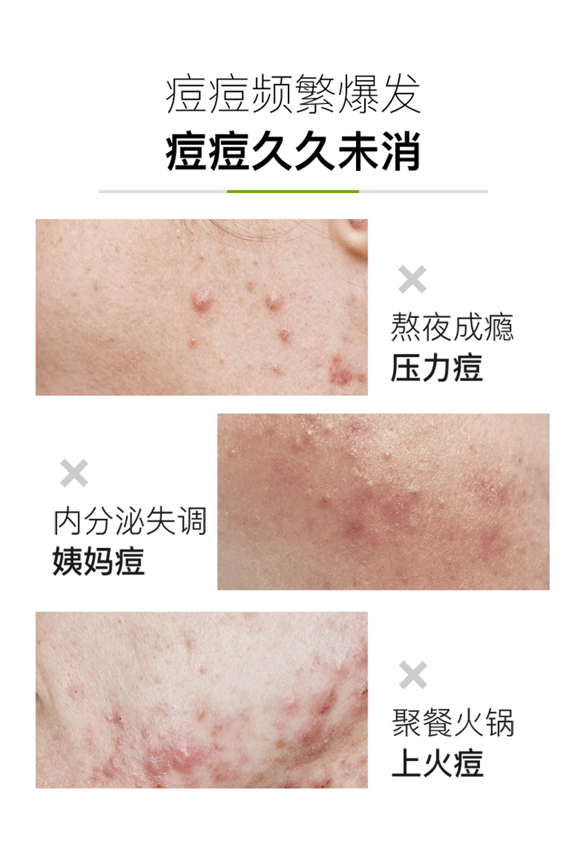 清爽控油祛痘套裝-詳情頁_02.jpg